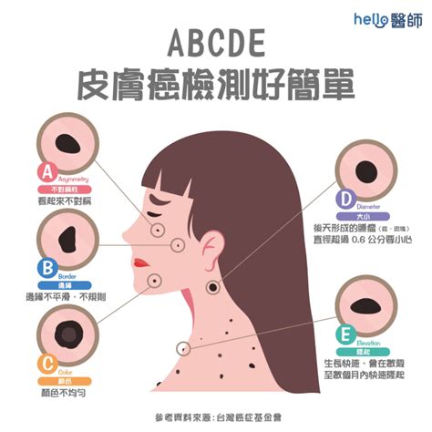 長痣的位置|健康網》長痣＝皮膚癌？ 醫提7症狀：善用ABCDE原。